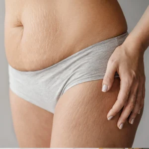 Celulitis